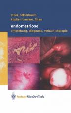 Cover-Bild Endometriose