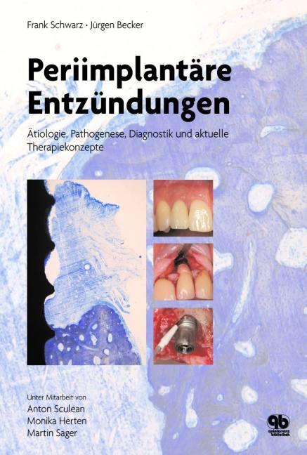 Cover-Bild Periimplantäre Entzündungen