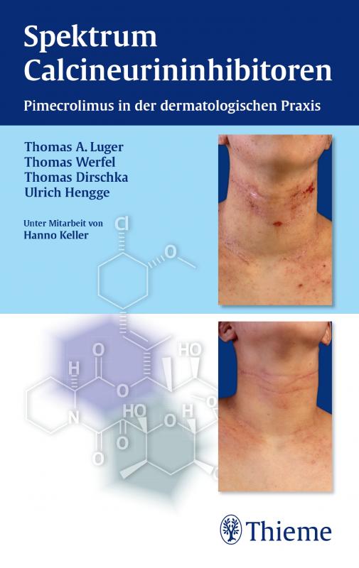 Cover-Bild Spektrum Calcineurininhibitoren: Pimecrolimus in der dermatologischen Praxis